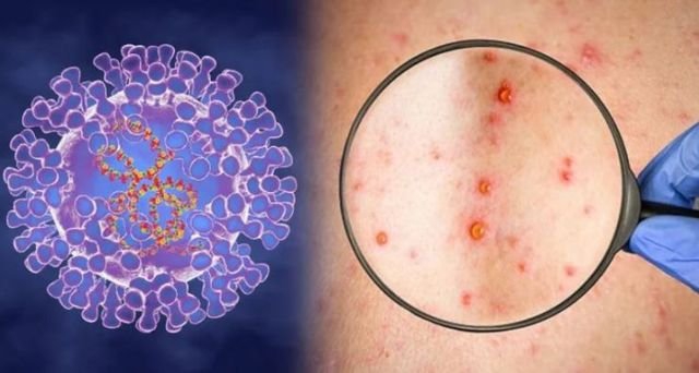 Phát hiện khác biệt di truyền trong virus đậu mùa khỉ năm 2022